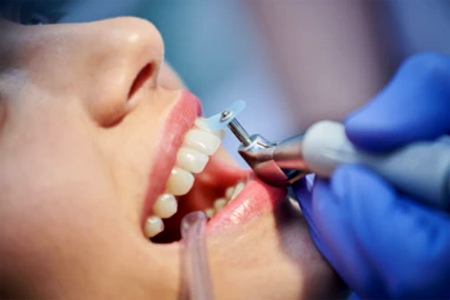 Чищення зубів у стоматолога у Сумах